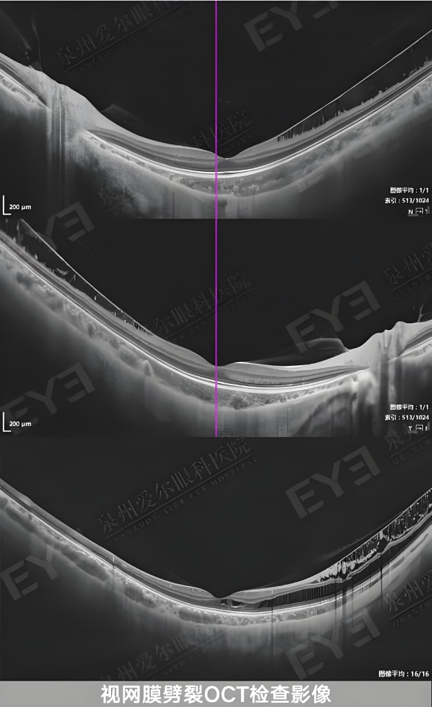 视网膜OCT检查影像