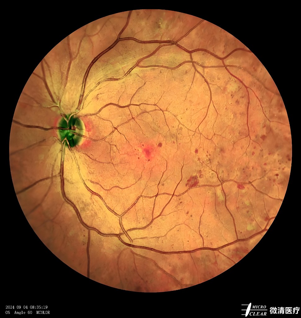 超广角眼底彩照